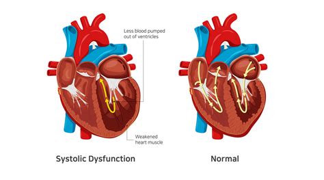 lv setje|Systolic Heart Failure: Symptoms, Causes and Treatment.